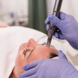 Microdermabrasion at Cameo College