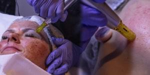 Micro-needling work at Cameo College