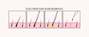 Electrolysis - Permanent Hair Removal