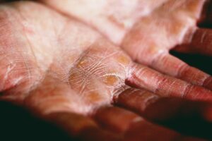 dry textured hands