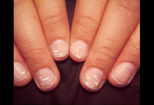 leukonychia - white spots on nails