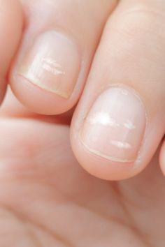 leukonychia - white spots on nail beds