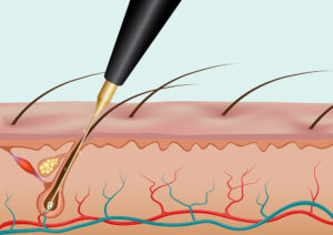Electrology in Utah, Permanent Hair Removal