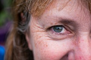 Tired Eye Treatment - a close up of a person with freckled hair