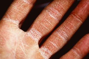 persons palm in close up photography | Dry Skin | Skincare Ingredients