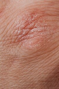 Close-up View Of Human Dry Skin