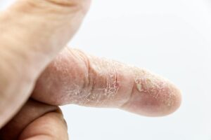 Detailed close-up of a human finger with dry and calloused skin showcasing texture and skin condition.