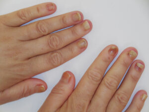 Nail Lifting, Onycholysis
