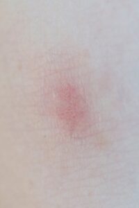Detailed view of a red skin rash or irritation on human skin.