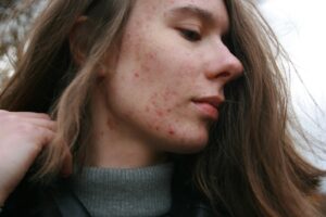 a woman with a substance on her face | Acne Scars